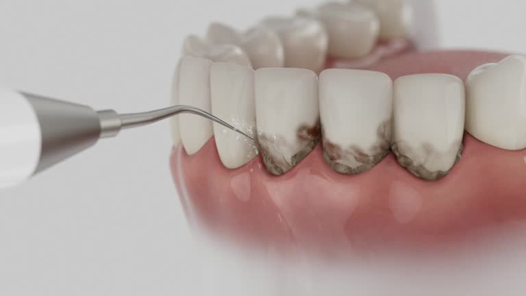 Trusted Wisdom Tooth Removal service in Clayton, OH - Dentist Open Now